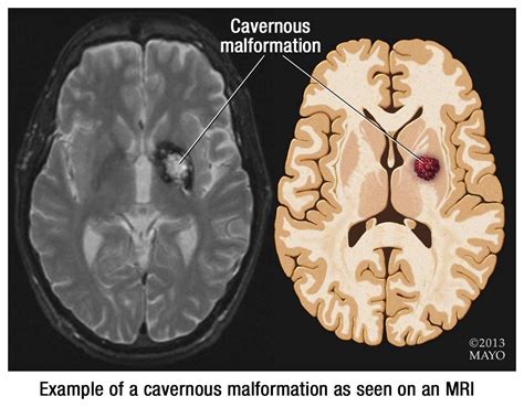 Mayo Clinic named Center of Excellence for cavernous malformation ...