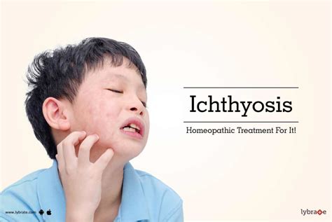 Ichthyosis - Homeopathic Treatment For It! - By Dr. Sonam Jain | Lybrate