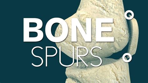 What causes bone spurs in knees? #whatcausesarthritis | Bone spurs ...