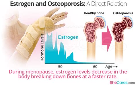 Estrogen And Osteoporosis A Direct Relation Shecares | Free Download ...