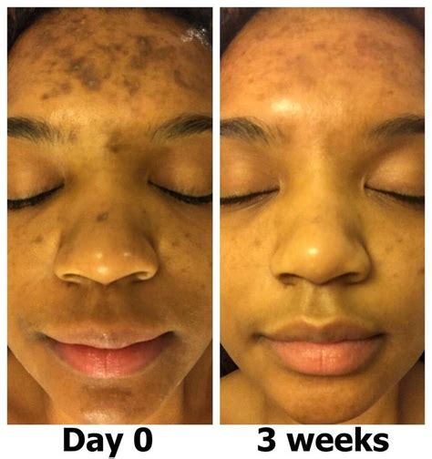 adapalene acne scars before after - Vanessa Anderson