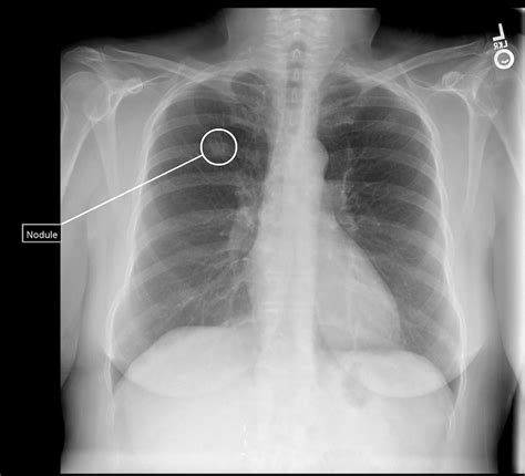 Qure.ai to Debut Multimodality AI Platform for Lung Cancer Imaging at ...