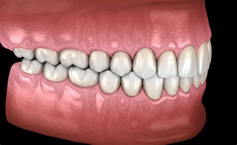 Occlusal Adjustments - New London, CT - Westerly, RI | Shoreline Periodontics and Dental Implants