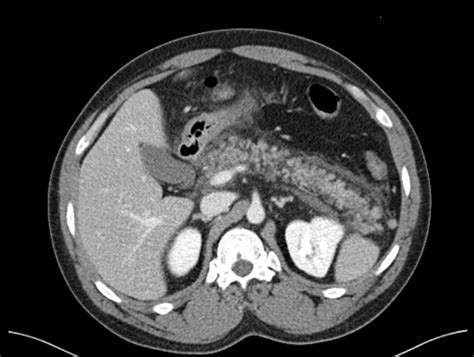 Cureus | COVID-19, Necrotizing Pancreatitis, and Abdominal Compartment Syndrome: A Perfect ...