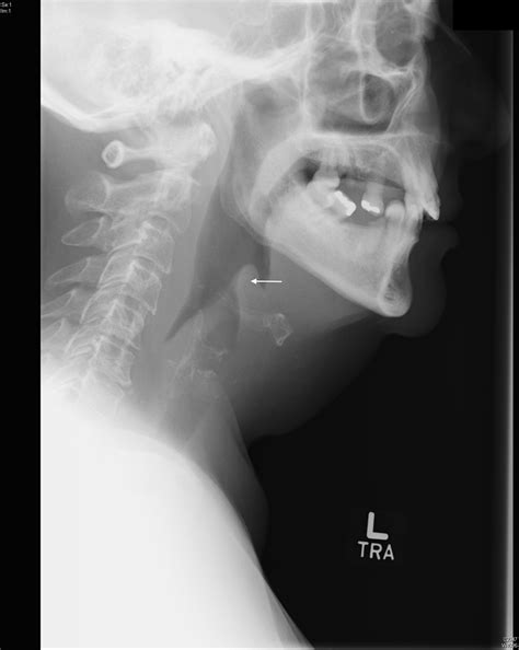 Epiglottitis X Ray