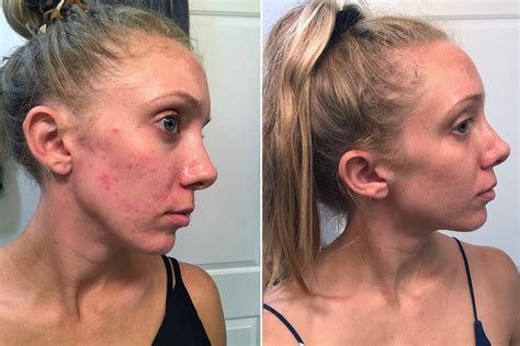 Acne, Fungal Acne or Dermatitis? How I Cured the Worst Skin of my Life – A Short Engagement