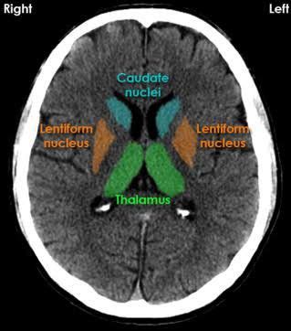 Lentiform Nucleus Mri