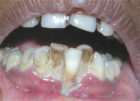 necrotizing periodontal disease - pictures, photos