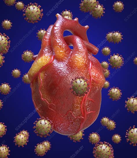 Heart inflammation in Covid-19, conceptual illustration - Stock Image ...