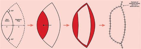 Design of a keystone fasciocutaneous advancement flap. | Download ...