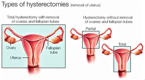 Hysterectomy reasons, types of hysterectomy & hysterectomy side effects