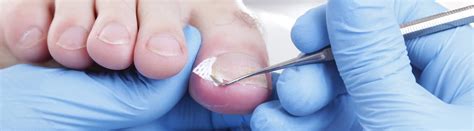 Toenail Fungus Treatment | Toenail Fungus Doctor Near Me