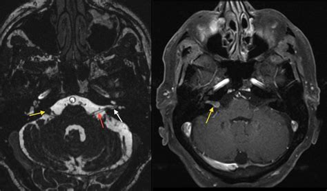 Acoustic neuroma - Radiology at St. Vincent's University Hospital