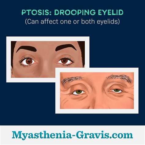 Common Symptoms of Myasthenia Gravis