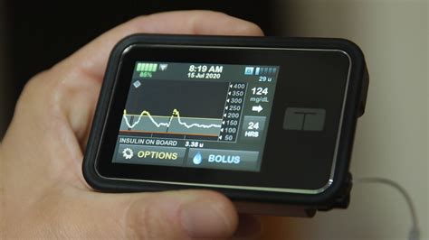 Insulin Pump and Continuous Glucose Monitor - HubPages