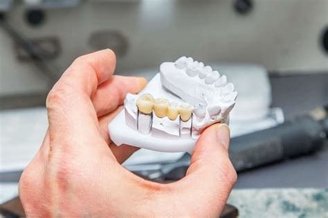 There are Four Types of Dental Bridges to Fill Gaps in Your Teeth