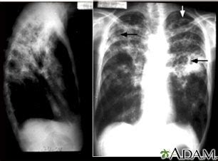 Disseminated tuberculosis | UF Health, University of Florida Health