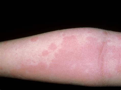 Food Allergy Skin Rash Treatment