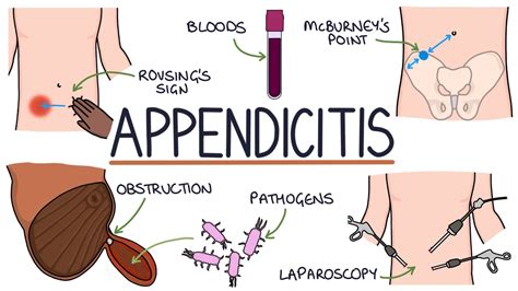 5 Appendicitis Symptoms and Warning Signs - Signs of Appendicitis, bursting to pee - mi-pro.co.uk