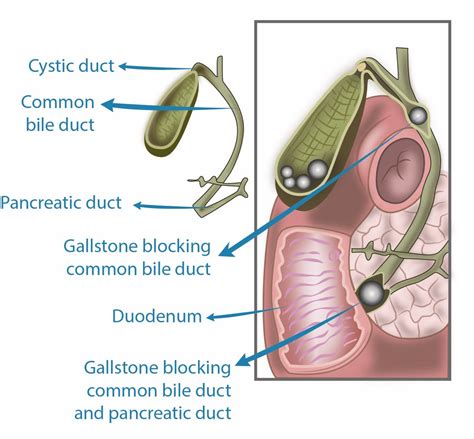 Pain Common Bile Duct Stones