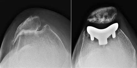 Patellofemoral Arthritis - OrthoInfo - AAOS