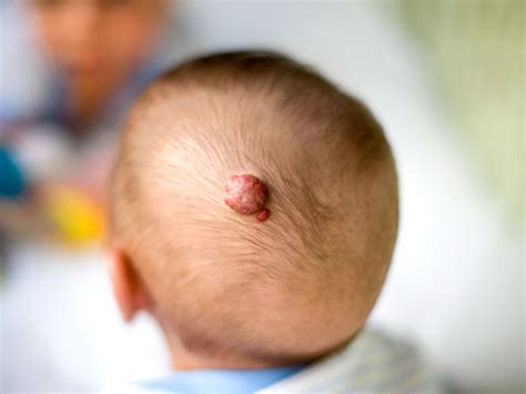 Hemangioma: Symptoms, Diagnosis, and Treatment