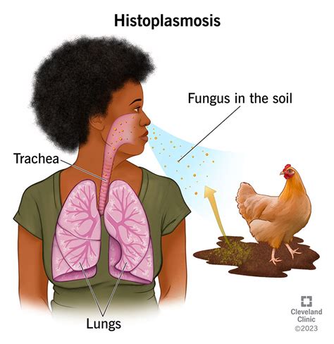 Histoplasmosis: Causes, Symptoms, Diagnosis Treatment, 42% OFF