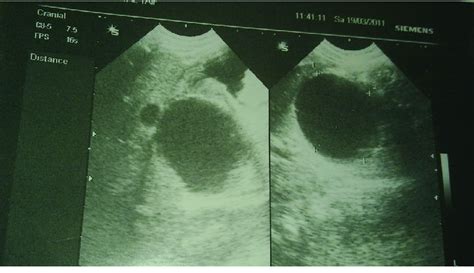 Ultrasound of the abdomen showing a cystic mass measuring 37× 33 mm at... | Download Scientific ...