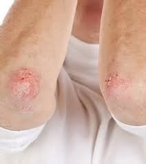 Dipylidium Infection | Mexico| PDF | PPT| Case Reports | Symptoms | Treatment