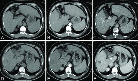 (A-F): Axial triple phase CT scan images [unenhanced (A), arterial (B),... | Download Scientific ...