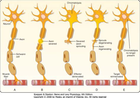 Wallerian degeneration | Neurology, Save