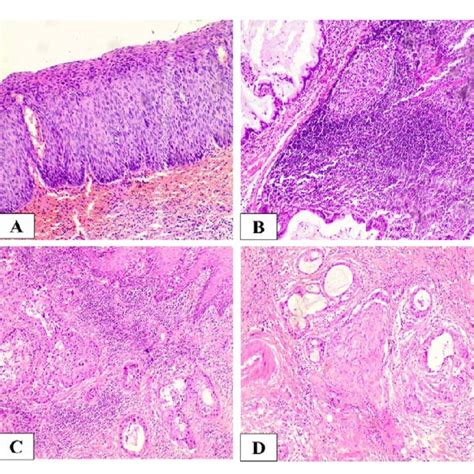 Histology of Squamous Cell Carcinoma after Routine H & E Staining: (A ...