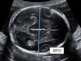 Fetal Biometrics | Pediatric Echocardiography