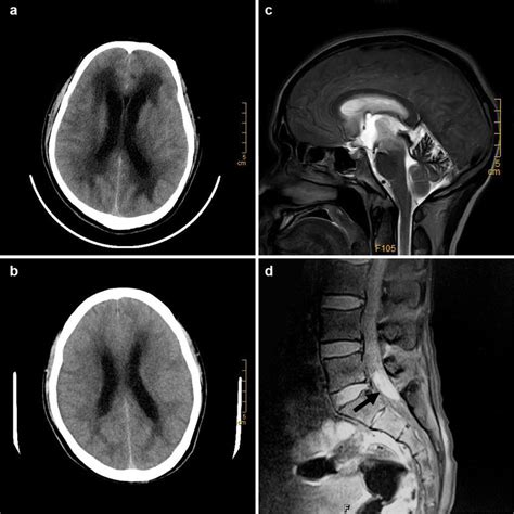 a, b CT scans of patient II:8, showing the hydrocephalus and ...