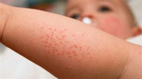 The Most Effective Treatments For Heat Rash - Health Cautions
