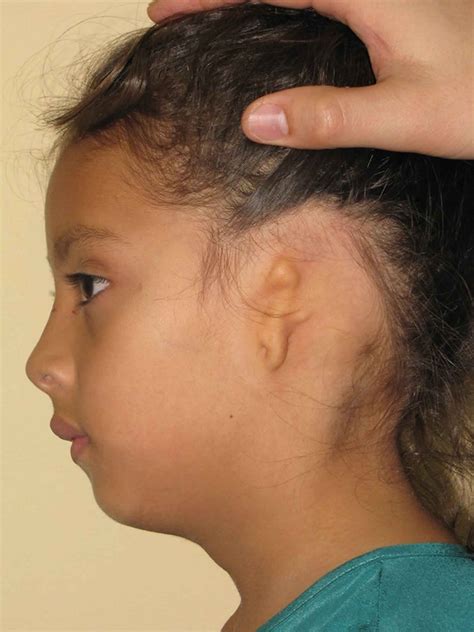 Aural atresia causes, symptoms, diagnosis, treatment & prognosis