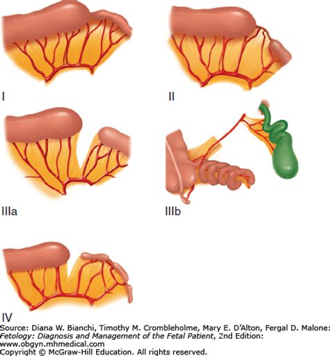 Jejunoileal Atresia and Stenosis | Obgyn Key