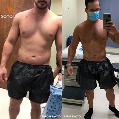 How Erik Got Rid of Stubborn Fat with TriSculpt