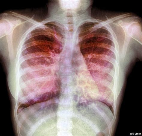 Gene therapy stabilises lungs of cystic fibrosis patients | Cystic ...