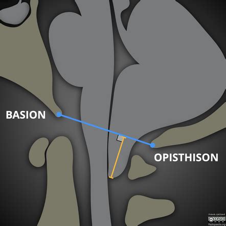 Cerebellar Tonsils Mri