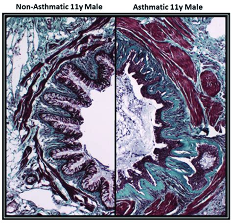 Features of airway remodeling in the large airways in asthma. Airway... | Download Scientific ...