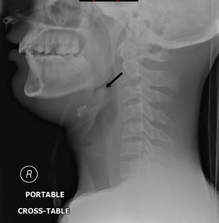 Epiglottitis Thumb Sign