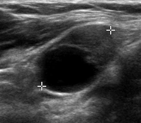 Diagnostic Approach for Evaluation of Lymph Node Metastasis From Thyroid Cancer Using Ultrasound ...