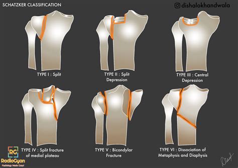 Schatzker Classification of Tibial Plateau Fractures | Tibial plateau ...