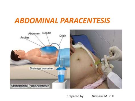 Abdominal paracentesis