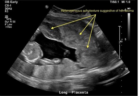 Cureus | Management of Placental Abruption Following Blunt Abdominal Trauma