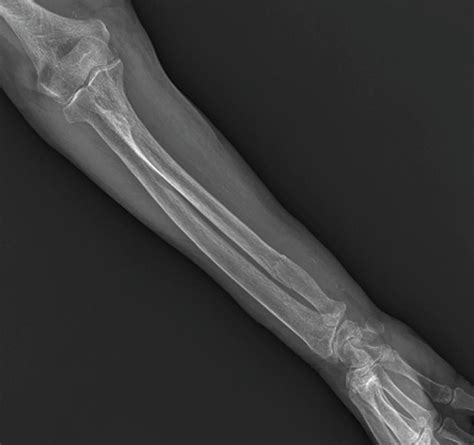 Fractured Ulna Arm Bone #2 Photograph by Science Photo Library - Pixels