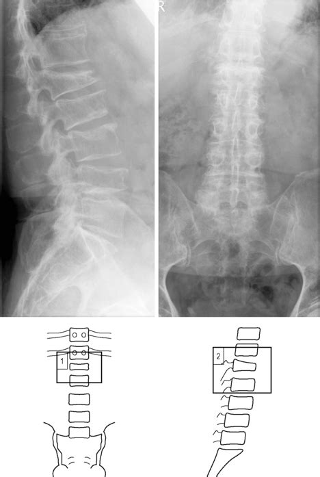 Vertebral fracture wedge compression | Radiology Key