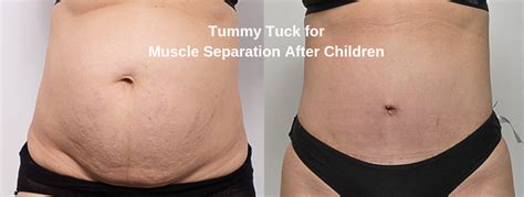 Tummy Tuck for Muscle Separation After Children, Diastasis Recti