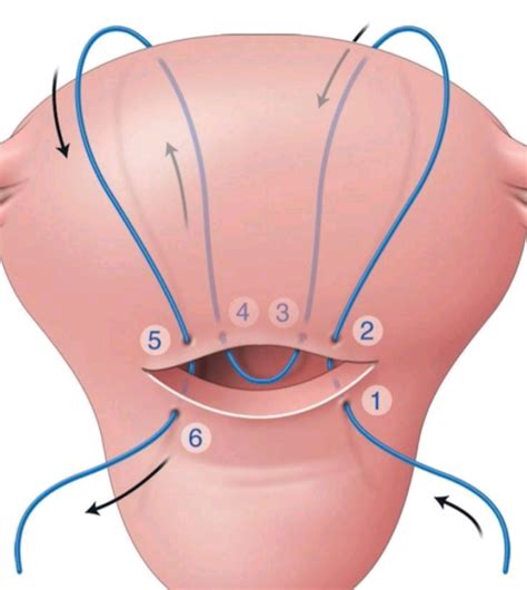 Important uterine sutures against atony – Meduweb